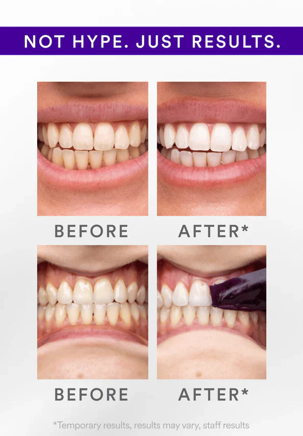 Whitening Strips: ‘’The Fast Track to a Stunning Smile!‘’✨