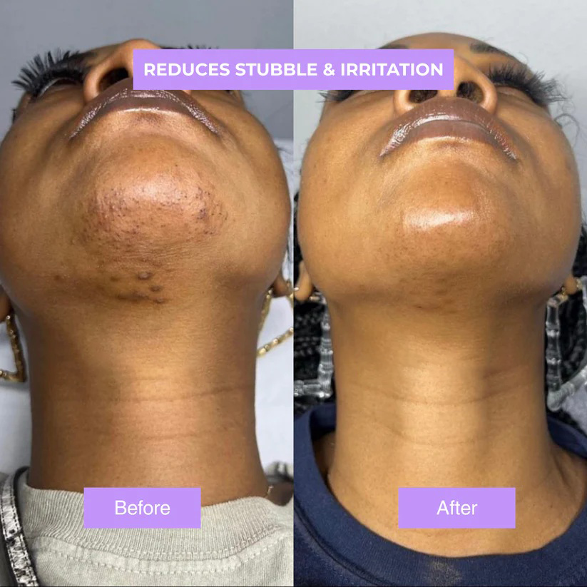 Cyperus Rotundus Skin Serum