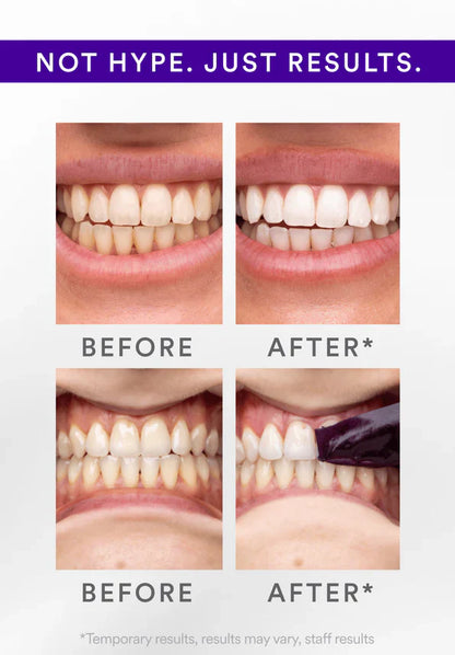 Whitening Strips: ‘’The Fast Track to a Stunning Smile!‘’✨