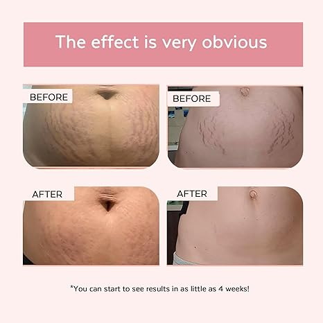 🔥 Smooth Skin Duo: Get Firm, Tight & Glowing in 30 Days! ✨ See Visible Results 🔥