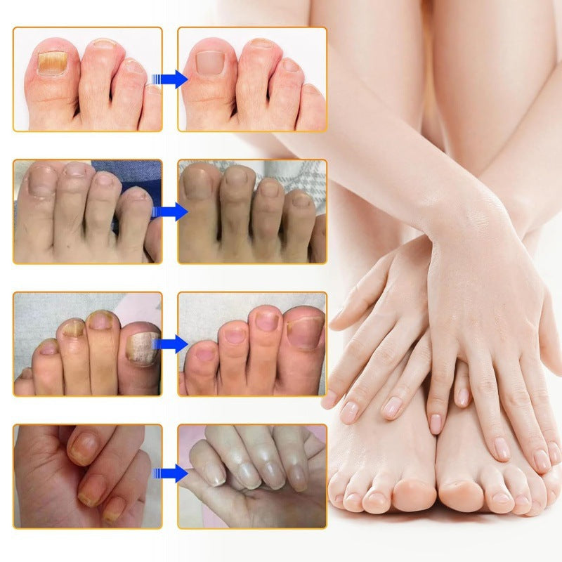 Fungal Nail Treatment Patches | 32 Count 🍄 8-Hour Overnight Repair 💤✨ Advanced Hydrogel Technology 💧🔬