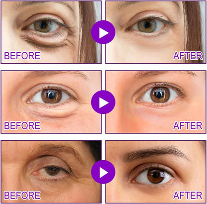 Micro Eye Patches, Under Eye Patches for Puffy Eyes and Dark Circles