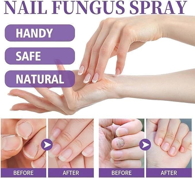🔥Limited time offer 🔥PLANT-BASED ANTI-FUNGAL SPRAY (Clinically Approved)