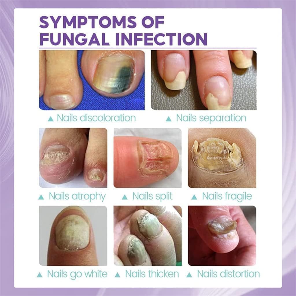 🔥Limited time offer 🔥PLANT-BASED ANTI-FUNGAL SPRAY (Clinically Approved)