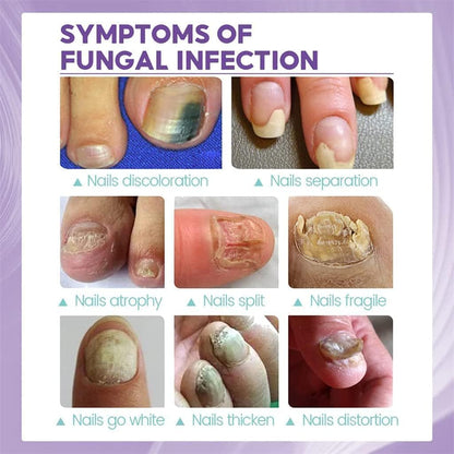 🔥Limited time offer 🔥PLANT-BASED ANTI-FUNGAL SPRAY (Clinically Approved)